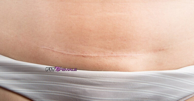 So startest du nach einem kaiserschnitt wieder mit dem training