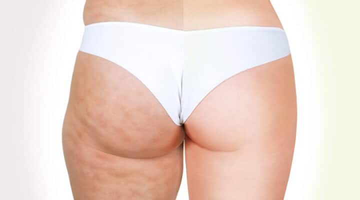 Tipps gegen cellulite