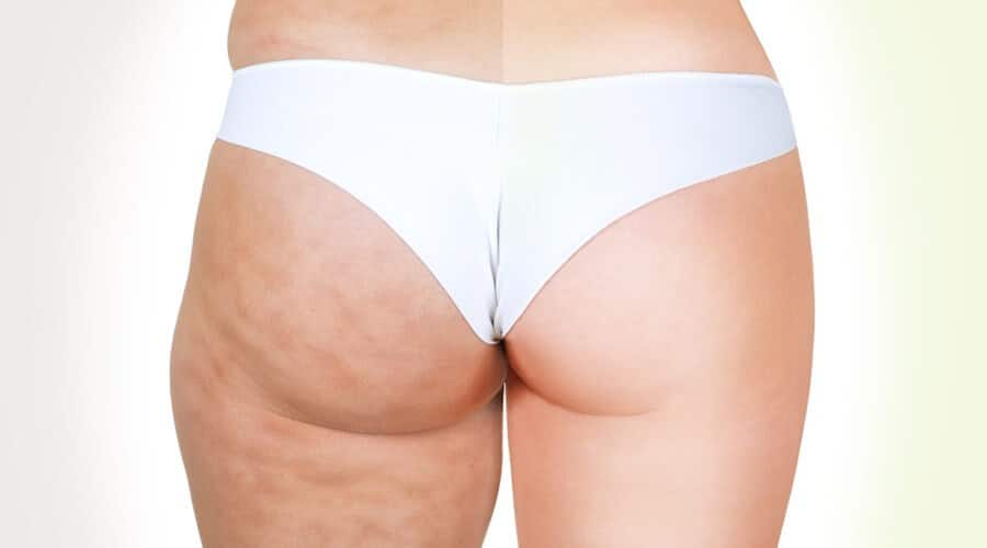 Tipps gegen cellulite