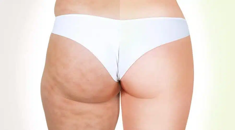 Consigli contro la cellulite