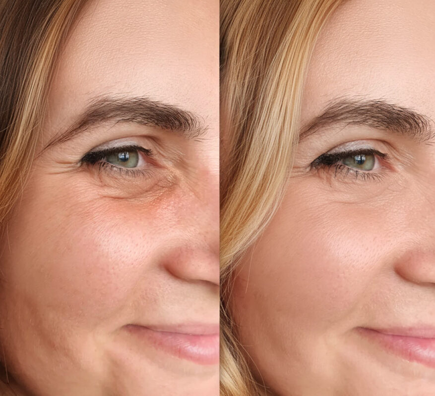 Collagen vorher nachher