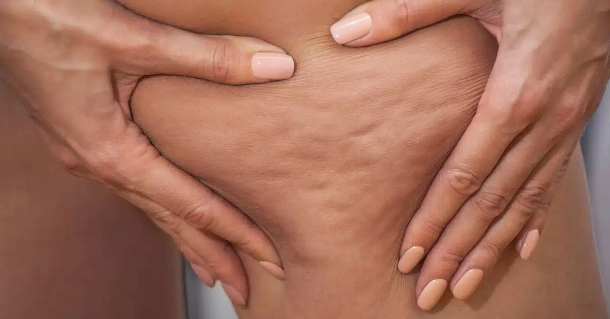 Weak connective tissue